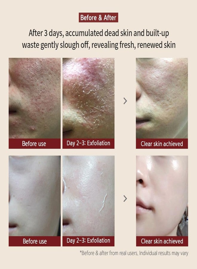 BQCELL [BQCELL] [Made In Korea] [DERMA SKIN PEELING 2g / Recell Cure Serum 2ml, Safety Cap 1ea, 3set], Acne Skin Available, Exfoliating, Facial Scrub, Korean Beauty, Blackhead Remover - Image 3